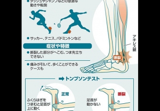 アキレス腱断裂