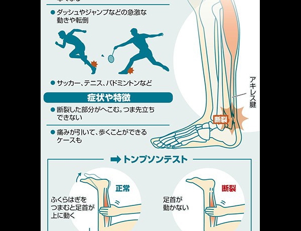 アキレス腱断裂