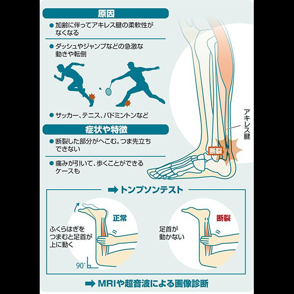 アキレス腱断裂